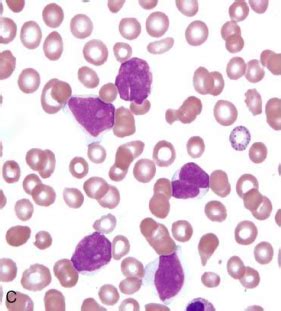 Mature Lymphoid Neoplasms II Flashcards Quizlet