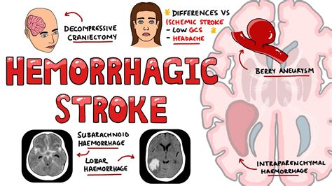 Hemorrhagic Stroke - Intracerebral Hemorrhage & Subarachnoid Hemorrhage ...