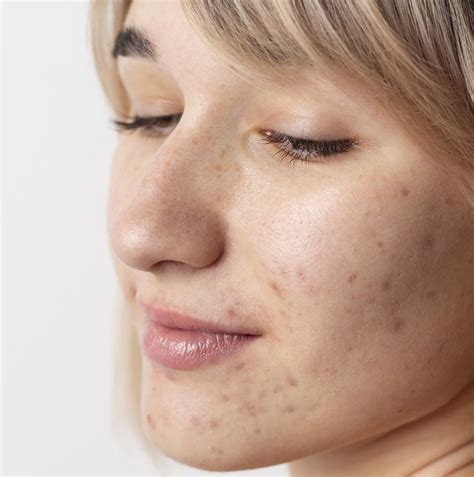 Acne Or Pimple Know About Symptoms Causes Types And Treatment Options