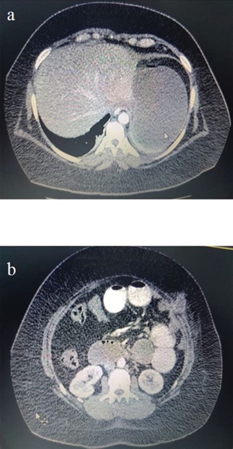 Gastric Remnant Perforation Due To Trocar Site Herniation After