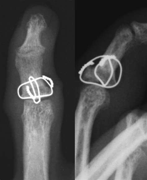 Late Post Operative Antero Posterior And Lateral Radiographs Of The