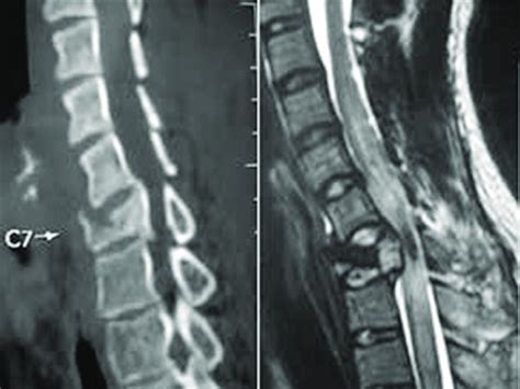 A CT Scan Cervical Spine Showing Compression Fracture C7 Vertebral