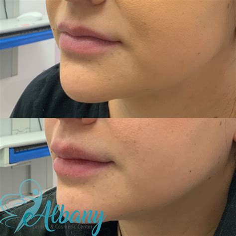 The Transformative Effects Of Lip Fillers Case No 1318 Albany