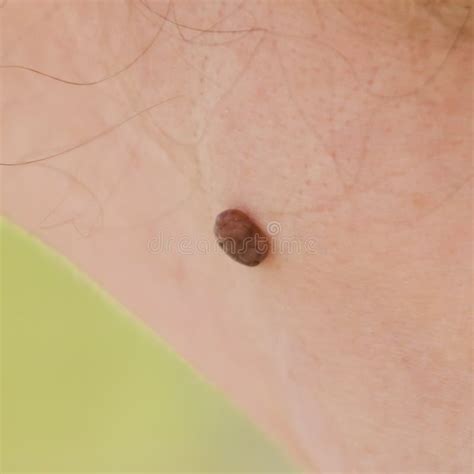 Birthmark On The Skin Of A Person Stock Photo Image Of Birthmark