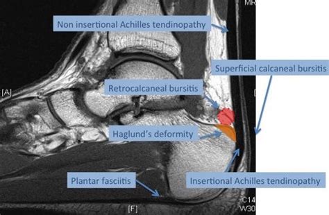 Achilles Tendon Rupture And Tendonitis Explained Orthopaedic Surgeon