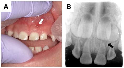 Endocrines Free Full Text Dental Manifestations And Oral Management Of X Linked Hypophosphatemia