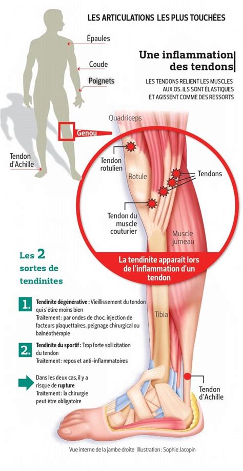 Tendinite Du Tendon D Achille Quest Ce Que Cest Fiches Sant Et