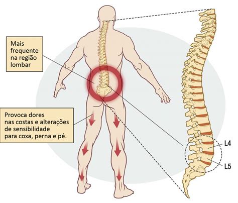 Dor Lombar Wr Medicina E Seguran A Do Trabalho