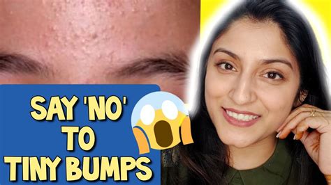 Days Challenge Treat Tiny Bumps On Foreheads Face Naturally