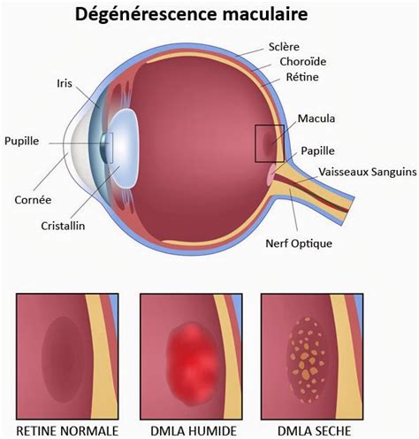 Blog Infos Sant Dmla D G N Rescence Maculaire Li E L Ge