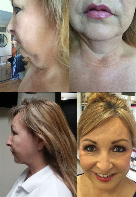 Amazing Before After Pictures Reveals Jaw Dropping Results