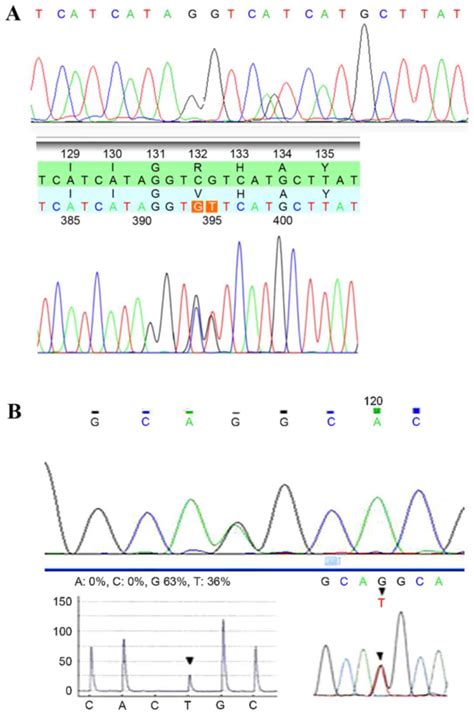 Association Between Idh12 Mutations And Brain Glioma Grade