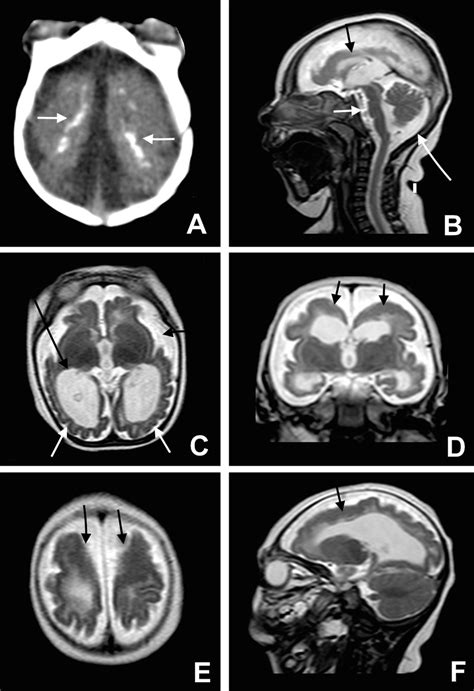 Microcephaly Cortical Malformation And Brain Calcification Axial