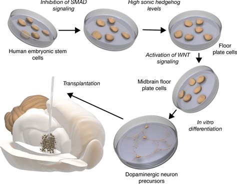 Clinical Translation Of Stem Cell Transplantation In Parkinson S