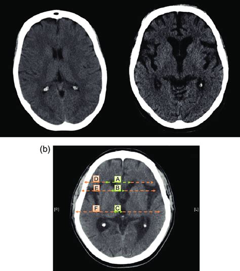 A A Brain Computerized Tomography Ct Of A Normal Control Left Download Scientific Diagram