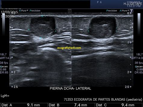 101 Ecografía de Partes Blandas Ecografía Fácil
