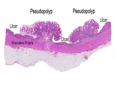 Inflammatory bowel disease