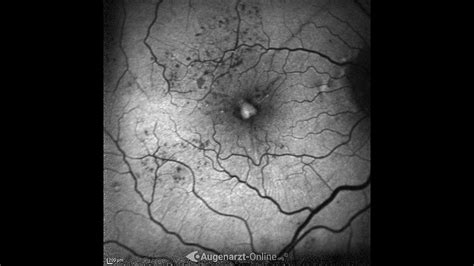 Diabetische Retinopathie Atlas Der Augenheilkunde