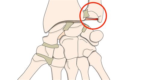 Entorses Du Poignet L Sions Ligamentaires Clinique Ost O