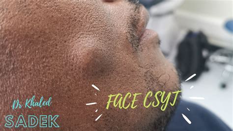 Massive Face Cyst DR Khaled Sadek LipomaCyst YouTube