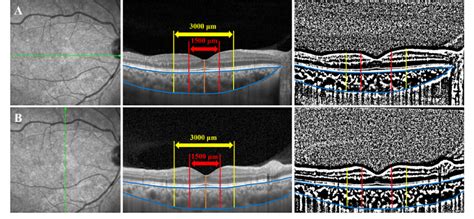 Enhanced Depth Imaging Spectral Domain Optical Coherence Tomography