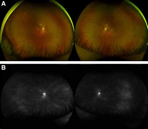 A Optos Ultra Widefield Pseudocolour Fundus Picture Showing Bilateral