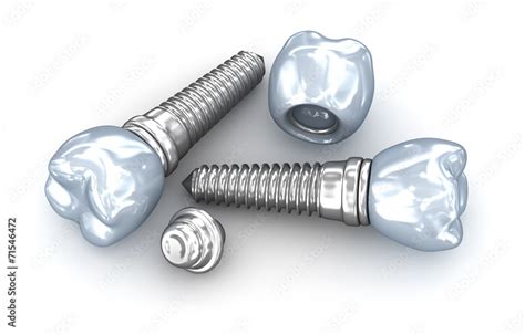 Dental Implants Crown With Pin Isolated On White Stock Illustration