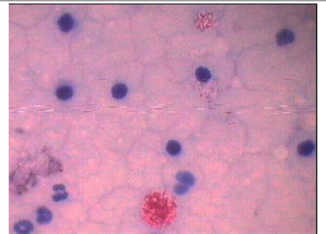 Figure 1 From Oculodermal Melancytosis The Nevus Of Ota