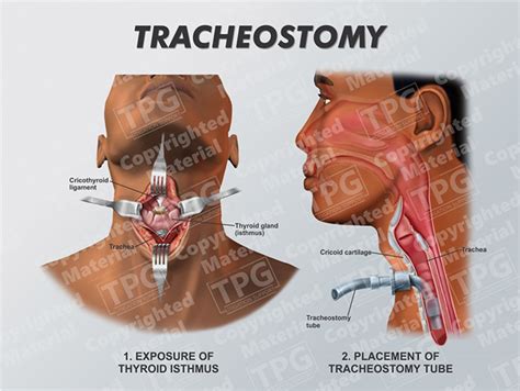 Tracheostomy Order