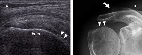 Glenohumeral Joint Radiology Key