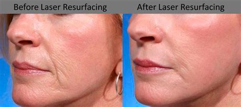 What Are The Side Effects Of Laser Resurfacing Health Blog Centre Info