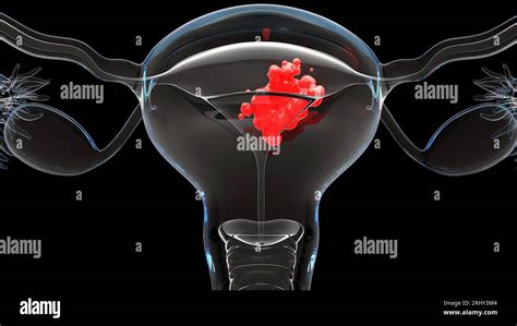 Tumore Maligno Dell Utero Anatomia Femminile Dell Utero Sistema