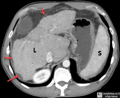 Learning Radiology - Cirrhosis, imaging, ascites