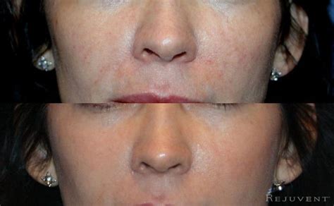 Veinwave Removes Facial Veins Rejuvent Medical Spa Scottsdale