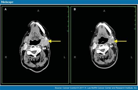 Radioactive Iodine: Ablation Of Thyroid With Radioactive Iodine