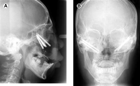 Reconstruction Of Extensive Maxillary Defects Using Zygomaticus