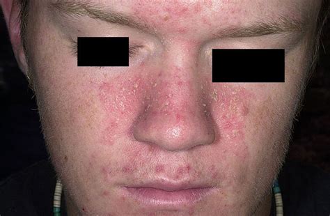 Dermatitis Seborreica Dermitek