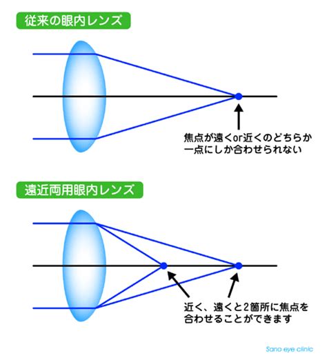 さの眼科 多焦点眼内レンズ