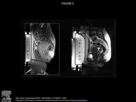 Noninvasive Treatment Of Uterine Fibroids Early Mayo Clinic Experience