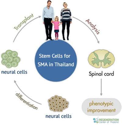 Stem Cell Treatment for SMA - Spinal Muscular Atrophy