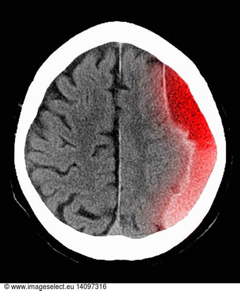 Subdural Hematoma Subdural Hematoma Ct Scan Brain Scan Brain Colorised