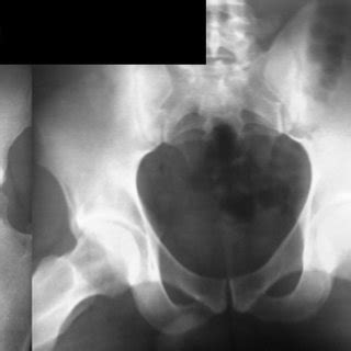 Anteroposterior Radiographic View Of A Right Hip The Tendon Appears