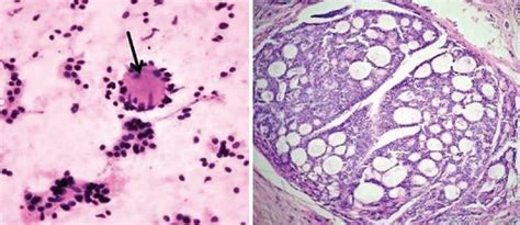 Adenoid Cystic Carcinoma - Symtomps, Treatment & Palate