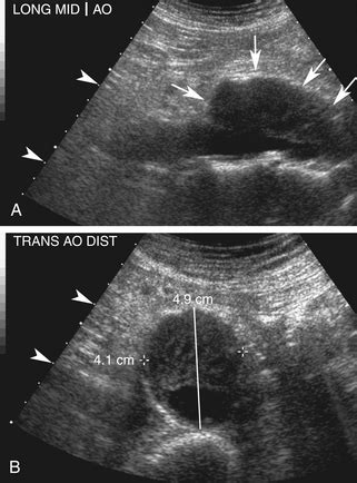 Ultrasound Assessment of the Abdominal Aorta | Radiology Key