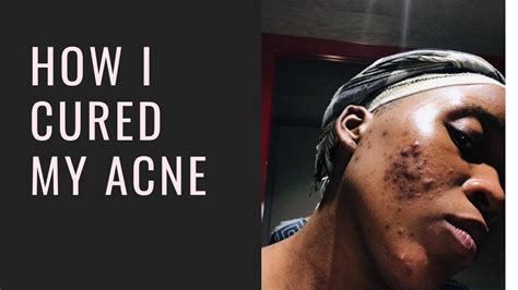 How I Cured My Acne Accutane Skin Care South African Youtuber Youtube