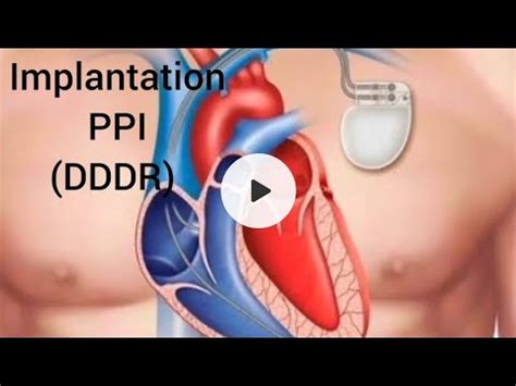 Permanent Pacemaker Implantation PPI DDDR Dual Chamber Complete