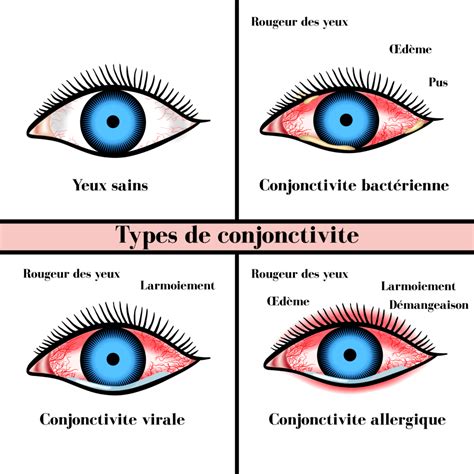 Conjonctivite Causes Symptômes Et Traitements Information