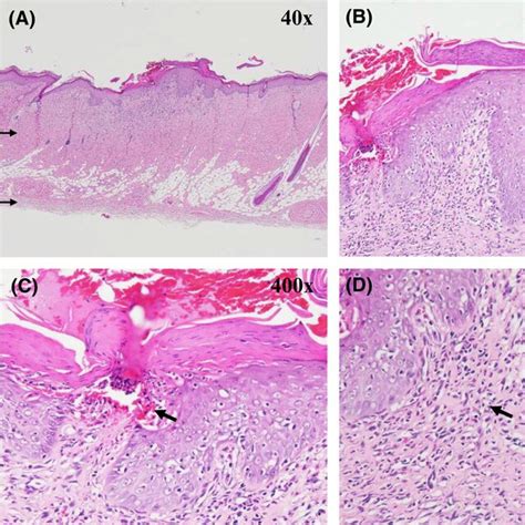 Histopathological Findings Of The Skin In Inflammation Side A And