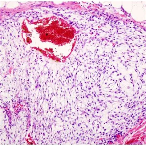 Ewing Sarcoma Symptoms Types Causes And Diagnosis