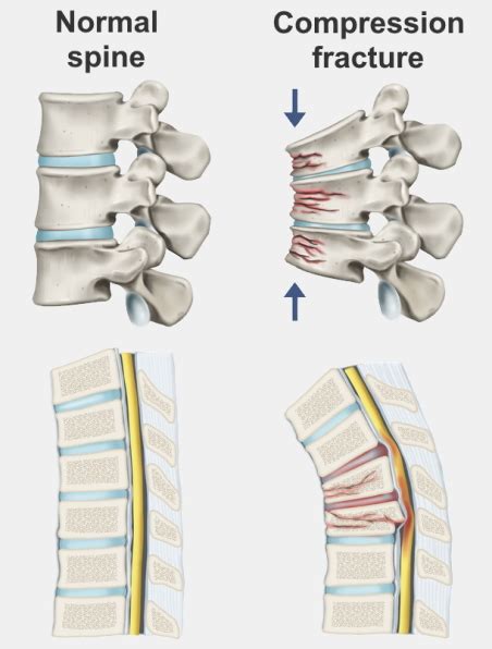 Vertebral Compression Fracture